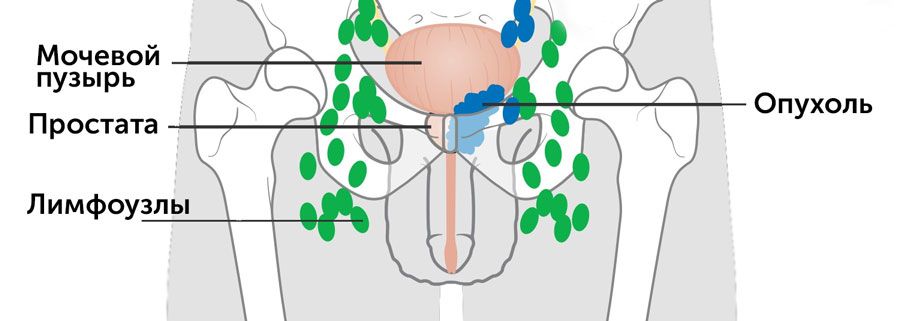Воспаление Лимфоузлов В Паху У Женщин Фото